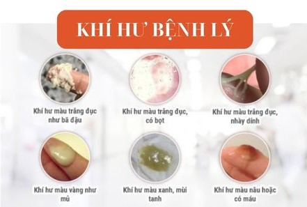 khí hư bệnh lý
