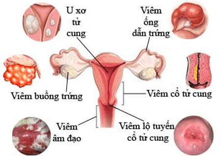 cac benh phu khoa thuong gap